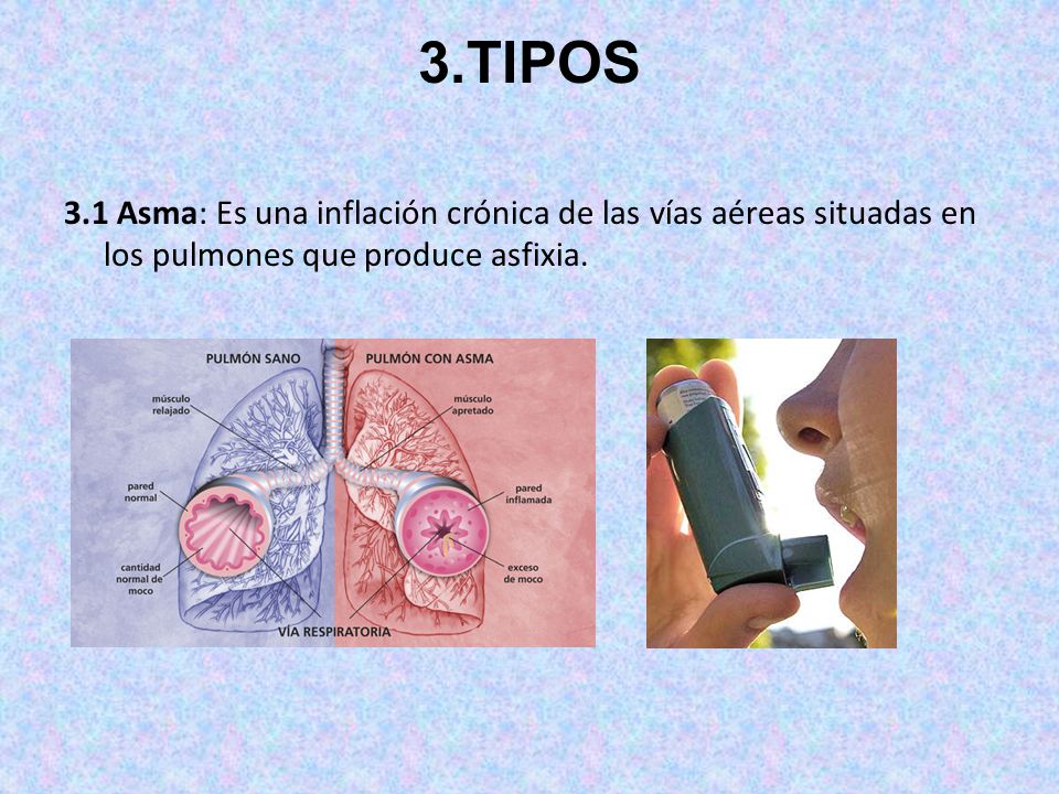 3.TIPOS 3.1 Asma: Es una inflación crónica de las vías aéreas situadas en los pulmones que produce asfixia.