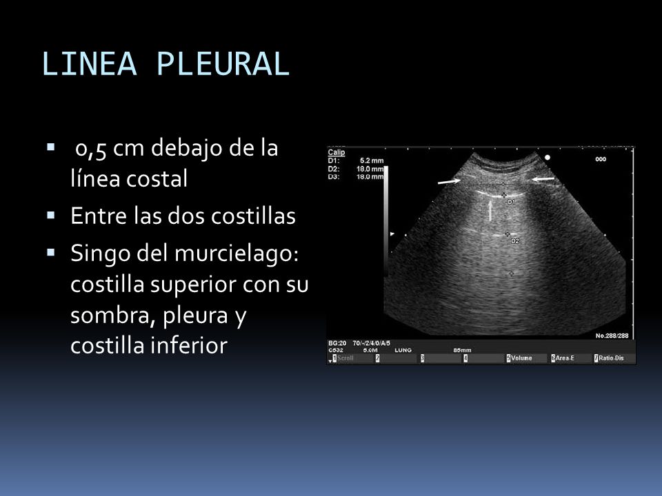LINEA PLEURAL 0,5 cm debajo de la línea costal Entre las dos costillas