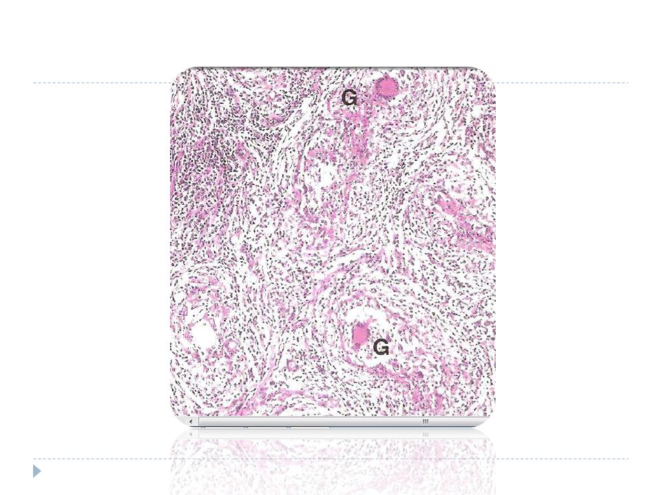 Infiltrado difuso de linfocitos, cells plasmáticas con la formacion de granulomas.