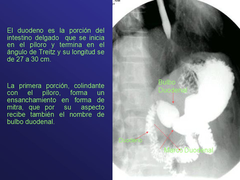 El duodeno es la porción del intestino delgado que se inicia en el píloro y termina en el ángulo de Treitz y su longitud se de 27 a 30 cm.