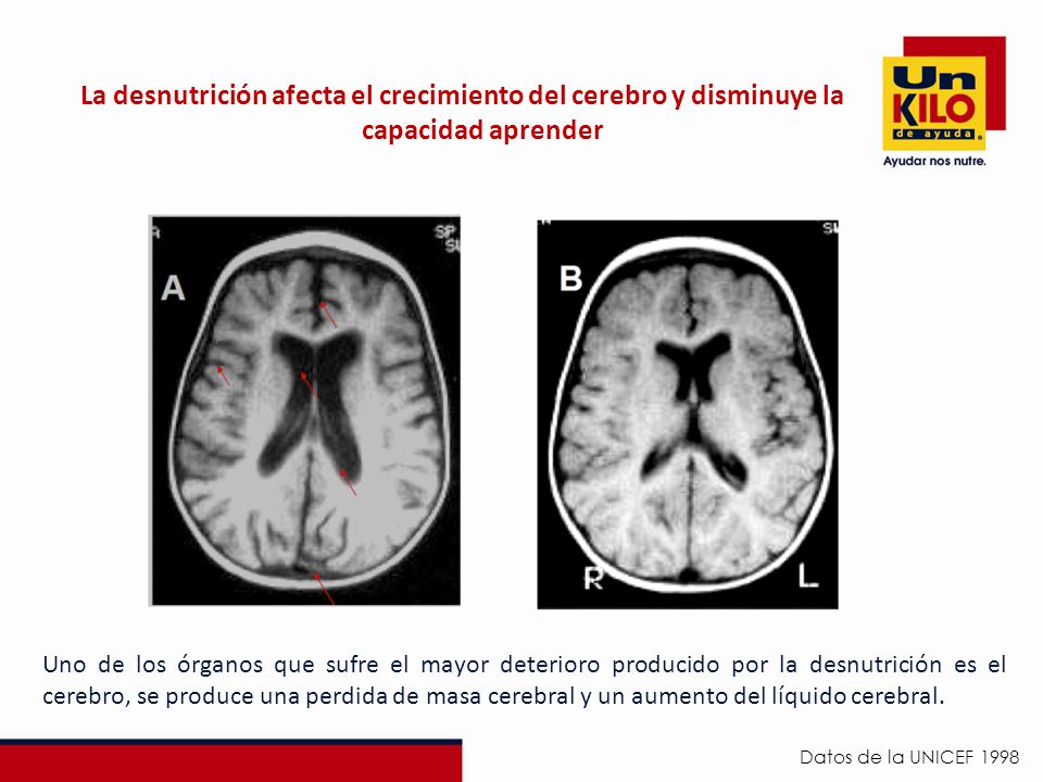 La desnutrición afecta el crecimiento del cerebro y disminuye la capacidad aprender