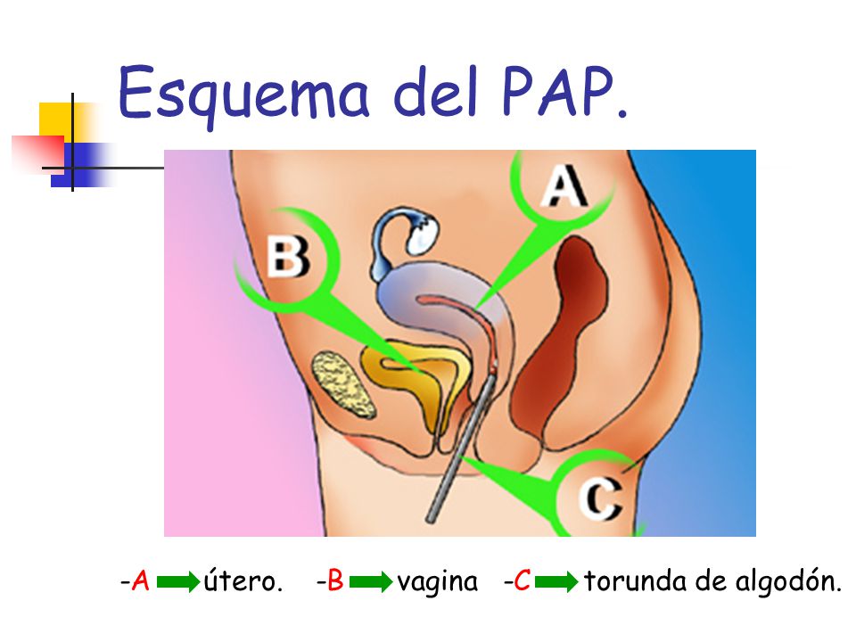 Esquema del PAP. -A útero. -B vagina -C torunda de algodón.