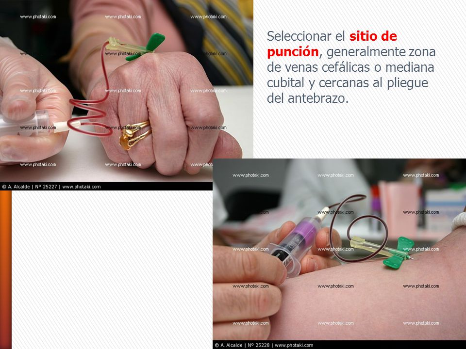 Seleccionar el sitio de punción, generalmente zona de venas cefálicas o mediana cubital y cercanas al pliegue del antebrazo.