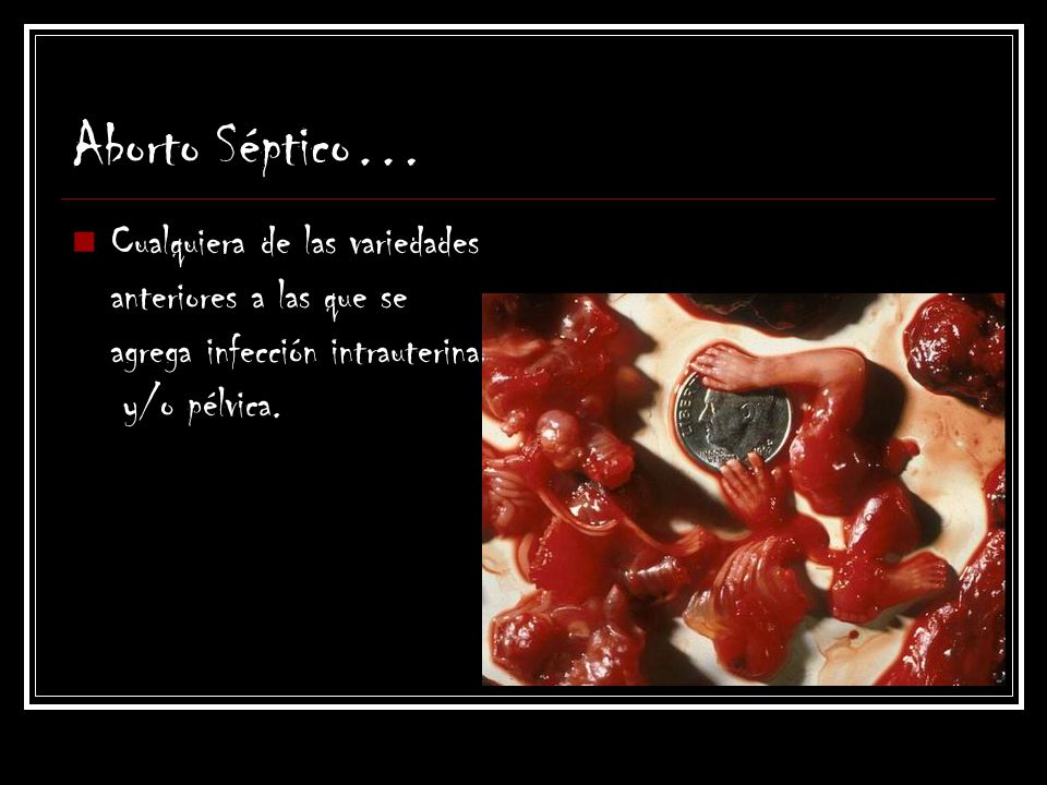 Aborto Séptico… Cualquiera de las variedades anteriores a las que se agrega infección intrauterina y/o pélvica.