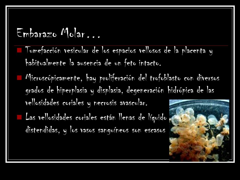 Embarazo Molar… Tumefacción vesicular de los espacios vellosos de la placenta y habitualmente la ausencia de un feto intacto.