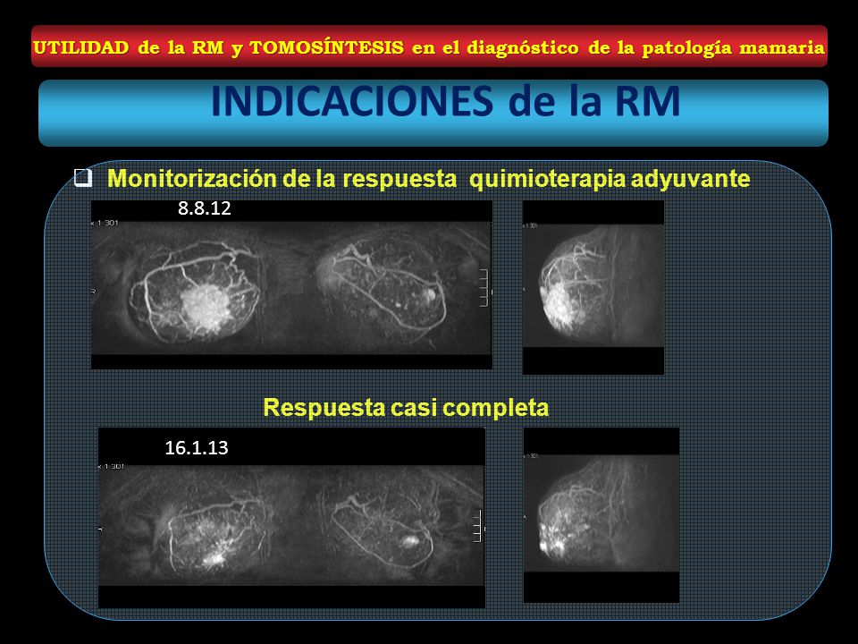 UTILIDAD de la RM y TOMOSÍNTESIS en el diagnóstico de la patología mamaria