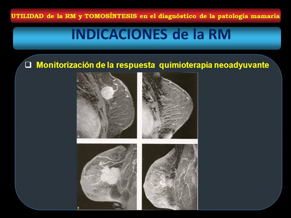 UTILIDAD de la RM y TOMOSÍNTESIS en el diagnóstico de la patología mamaria
