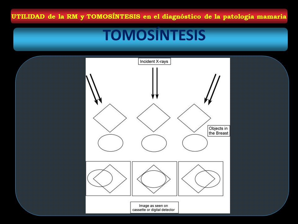 UTILIDAD de la RM y TOMOSÍNTESIS en el diagnóstico de la patología mamaria