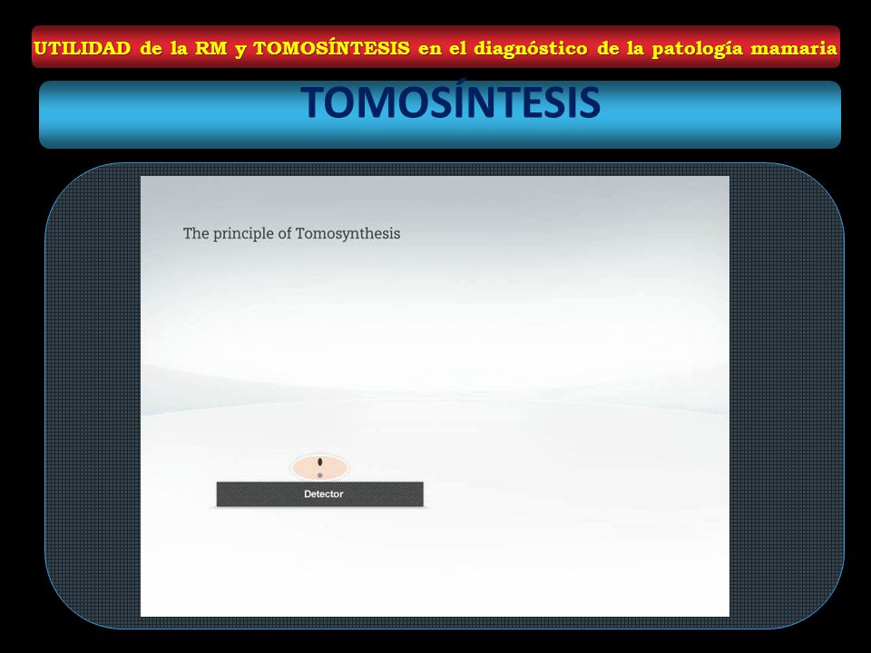 UTILIDAD de la RM y TOMOSÍNTESIS en el diagnóstico de la patología mamaria