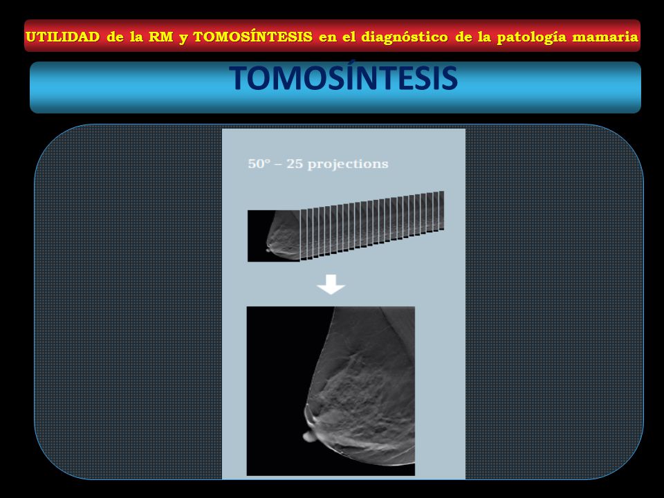 UTILIDAD de la RM y TOMOSÍNTESIS en el diagnóstico de la patología mamaria
