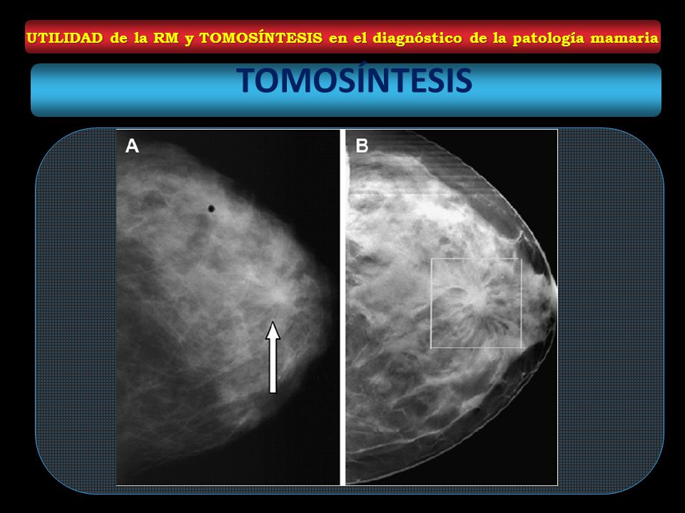 UTILIDAD de la RM y TOMOSÍNTESIS en el diagnóstico de la patología mamaria