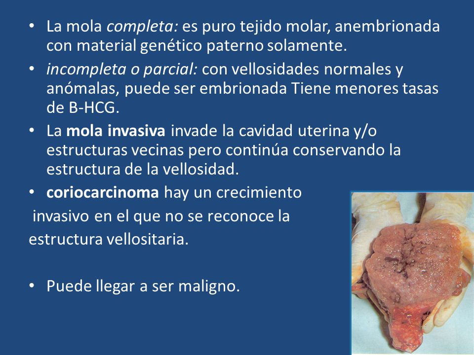 La mola completa: es puro tejido molar, anembrionada con material genético paterno solamente.