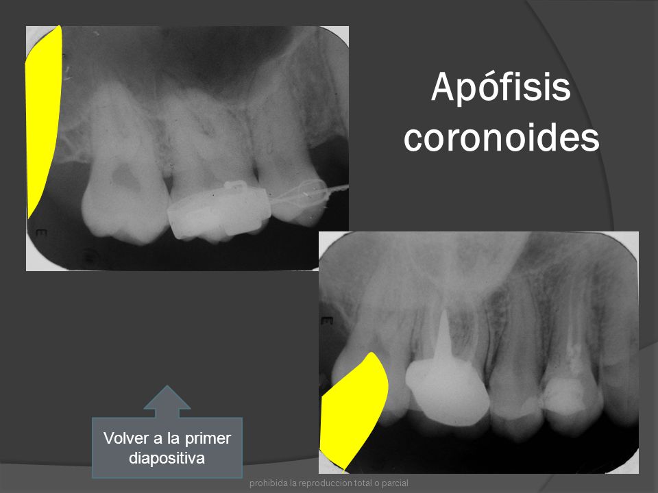 Apófisis coronoides Volver a la primer diapositiva