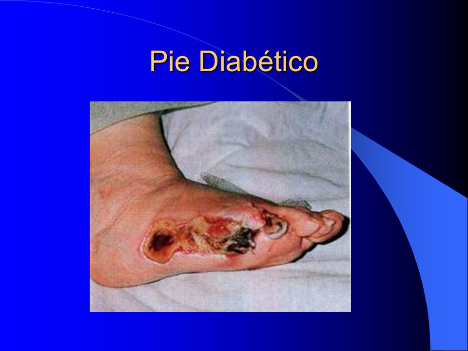 Pie Diabético