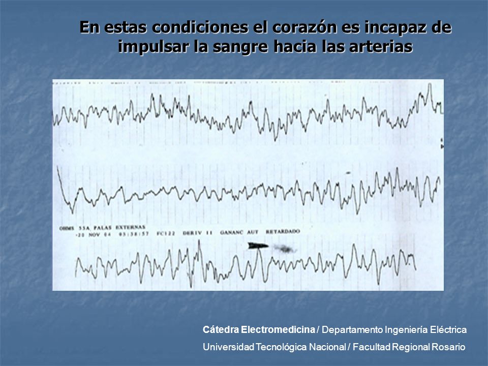 En estas condiciones el corazón es incapaz de impulsar la sangre hacia las arterias