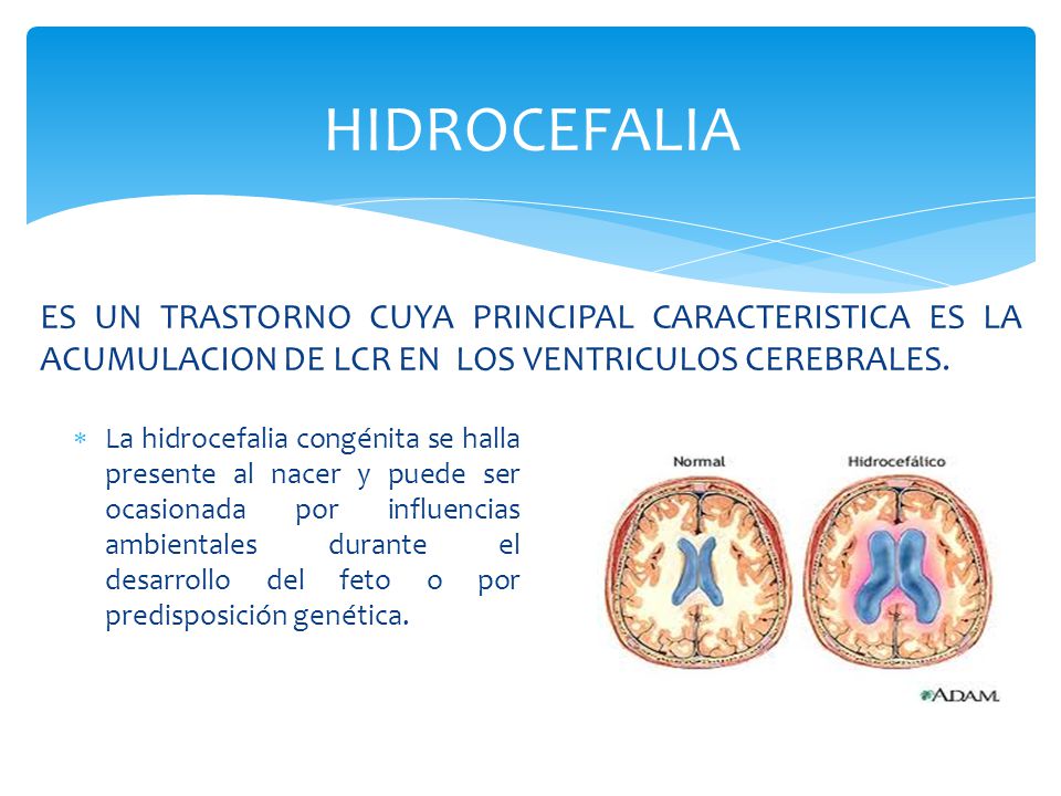 HIDROCEFALIA ES UN TRASTORNO CUYA PRINCIPAL CARACTERISTICA ES LA ACUMULACION DE LCR EN LOS VENTRICULOS CEREBRALES.