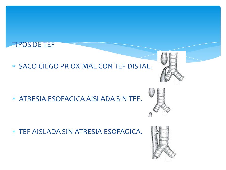 TIPOS DE TEF SACO CIEGO PR OXIMAL CON TEF DISTAL. ATRESIA ESOFAGICA AISLADA SIN TEF.