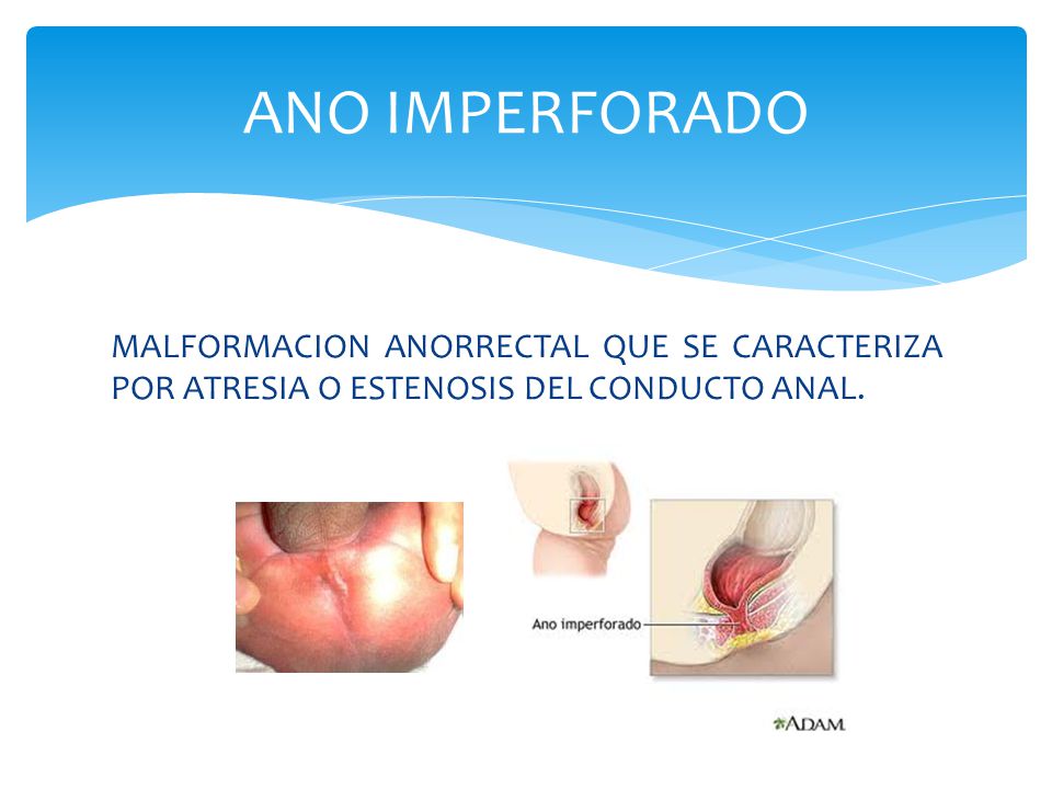 ANO IMPERFORADO MALFORMACION ANORRECTAL QUE SE CARACTERIZA POR ATRESIA O ESTENOSIS DEL CONDUCTO ANAL.
