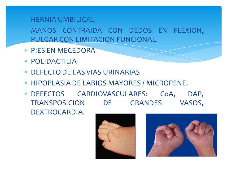 HERNIA UMBILICAL MANOS CONTRAIDA CON DEDOS EN FLEXION, PULGAR CON LIMITACION FUNCIONAL. PIES EN MECEDORA.