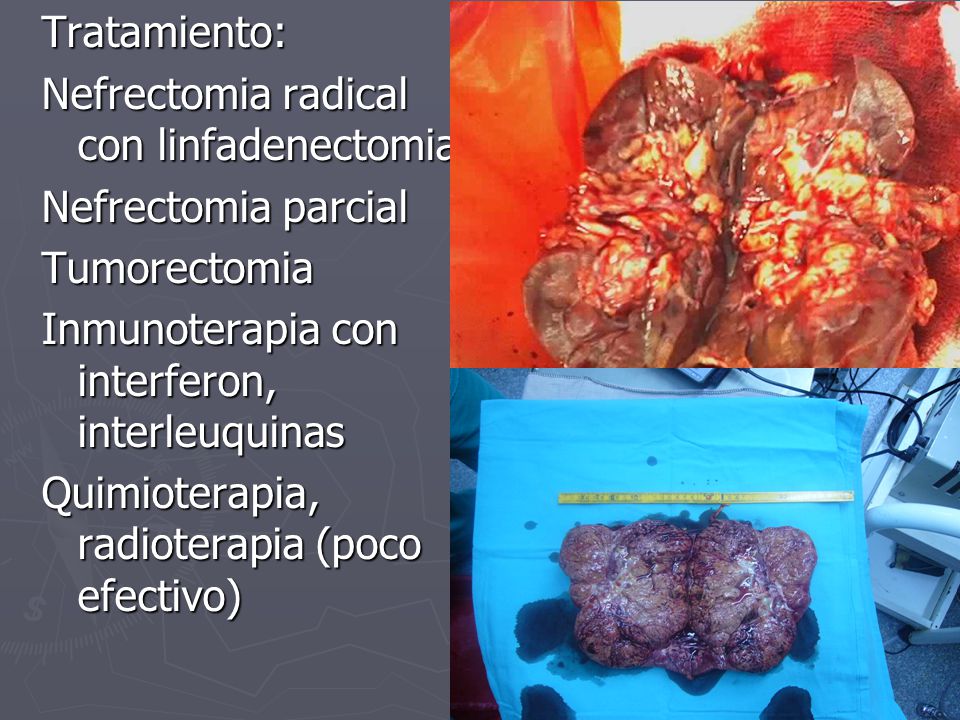 Tratamiento: Nefrectomia radical con linfadenectomia. Nefrectomia parcial. Tumorectomia. Inmunoterapia con interferon, interleuquinas.