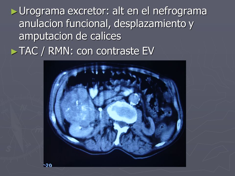 Urograma excretor: alt en el nefrograma anulacion funcional, desplazamiento y amputacion de calices