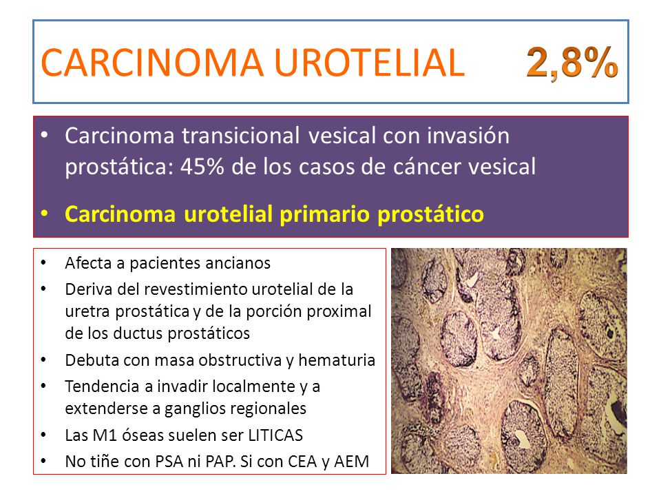 CARCINOMA UROTELIAL 2,8% Carcinoma transicional vesical con invasión prostática: 45% de los casos de cáncer vesical.