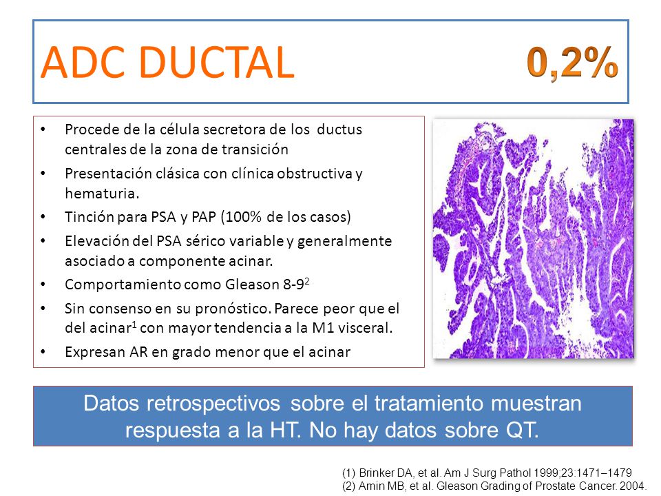 ADC DUCTAL 0,2% Procede de la célula secretora de los ductus centrales de la zona de transición.