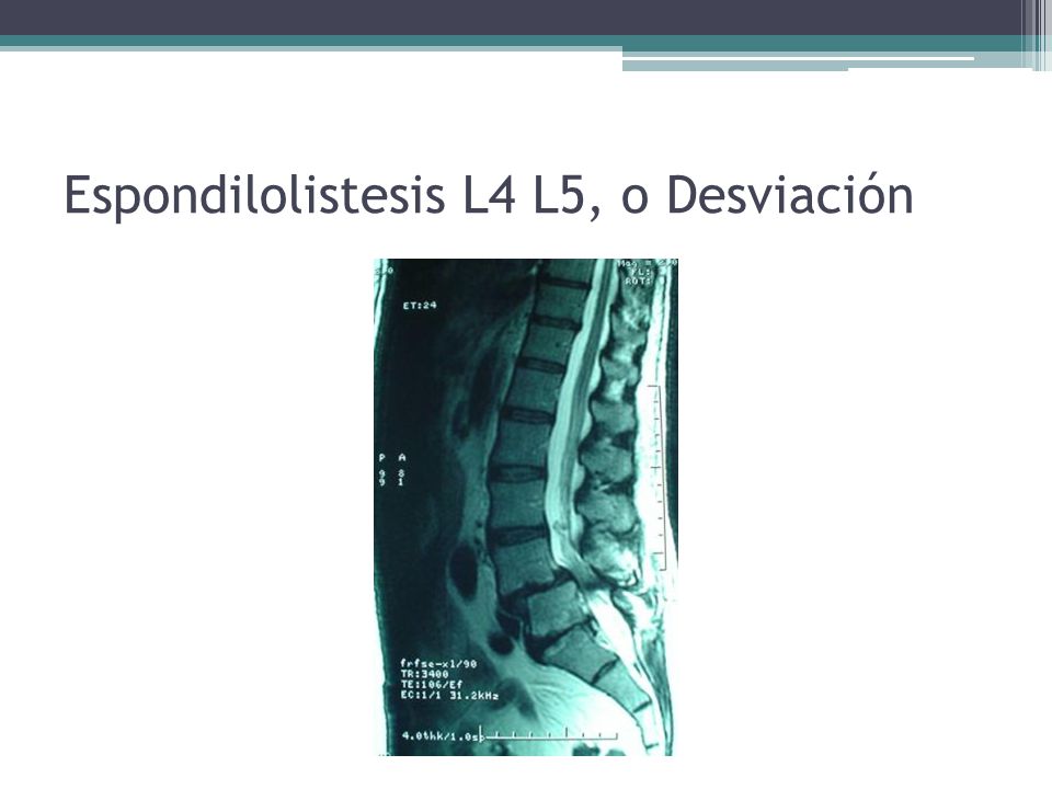 Espondilolistesis L4 L5, o Desviación