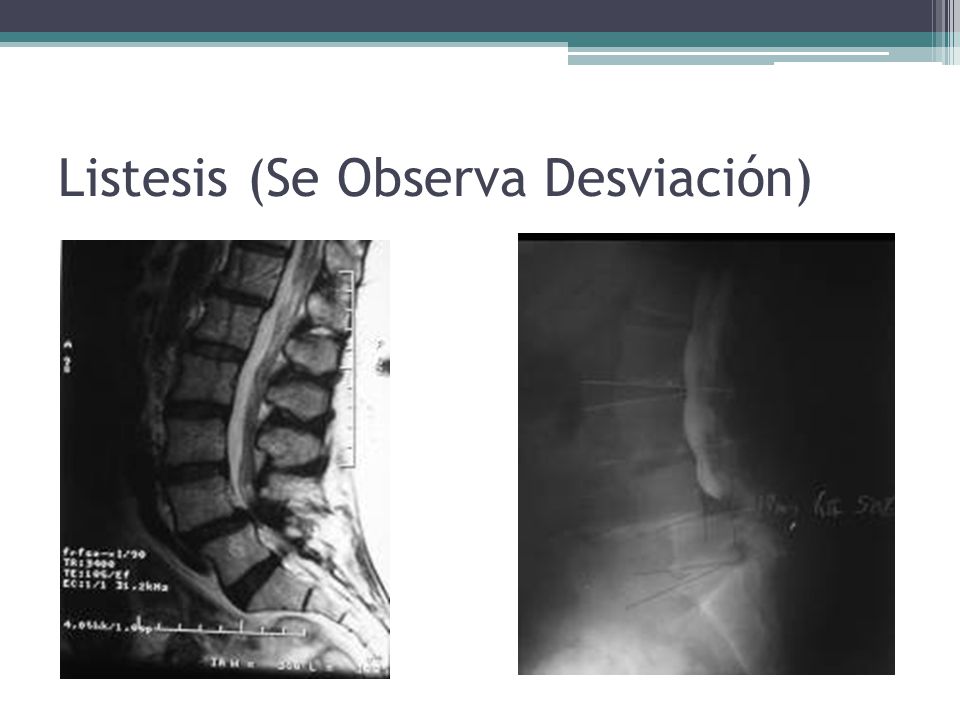 Listesis (Se Observa Desviación)