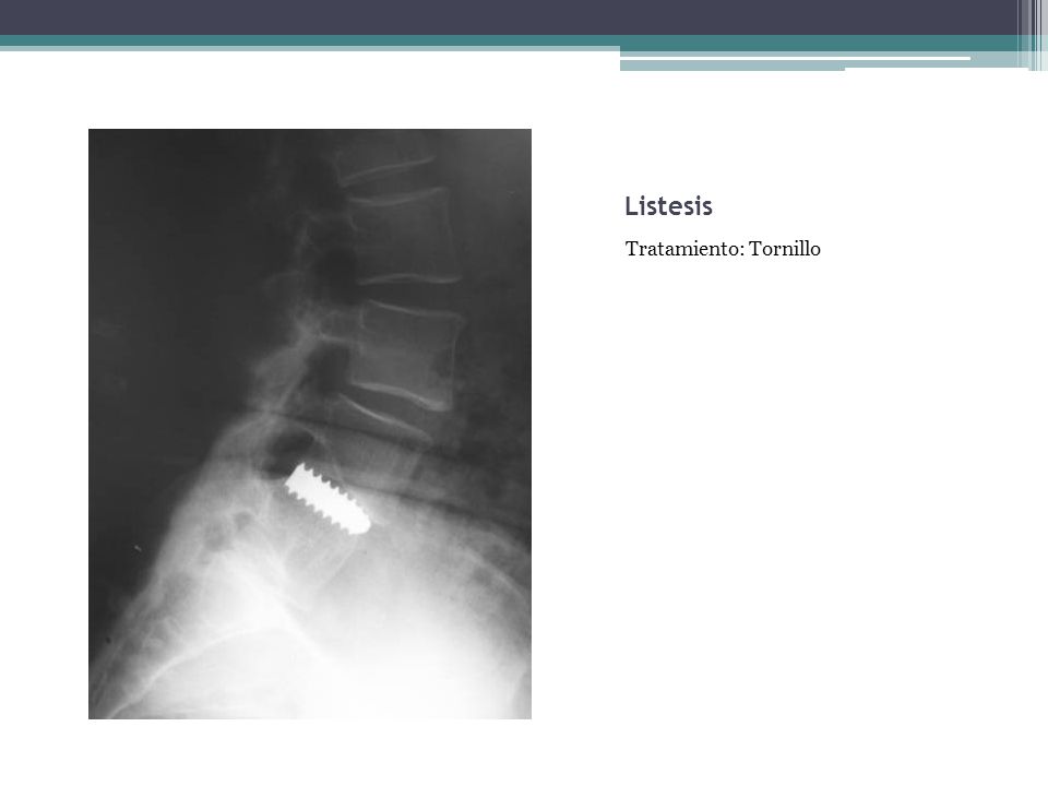Listesis Tratamiento: Tornillo