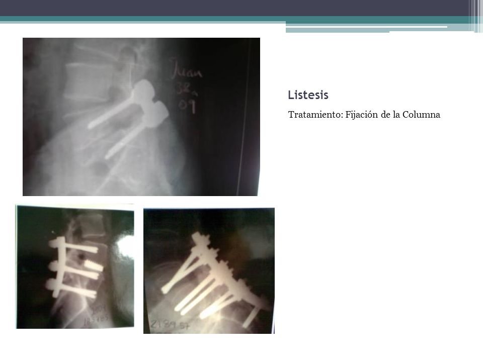 Listesis Tratamiento: Fijación de la Columna