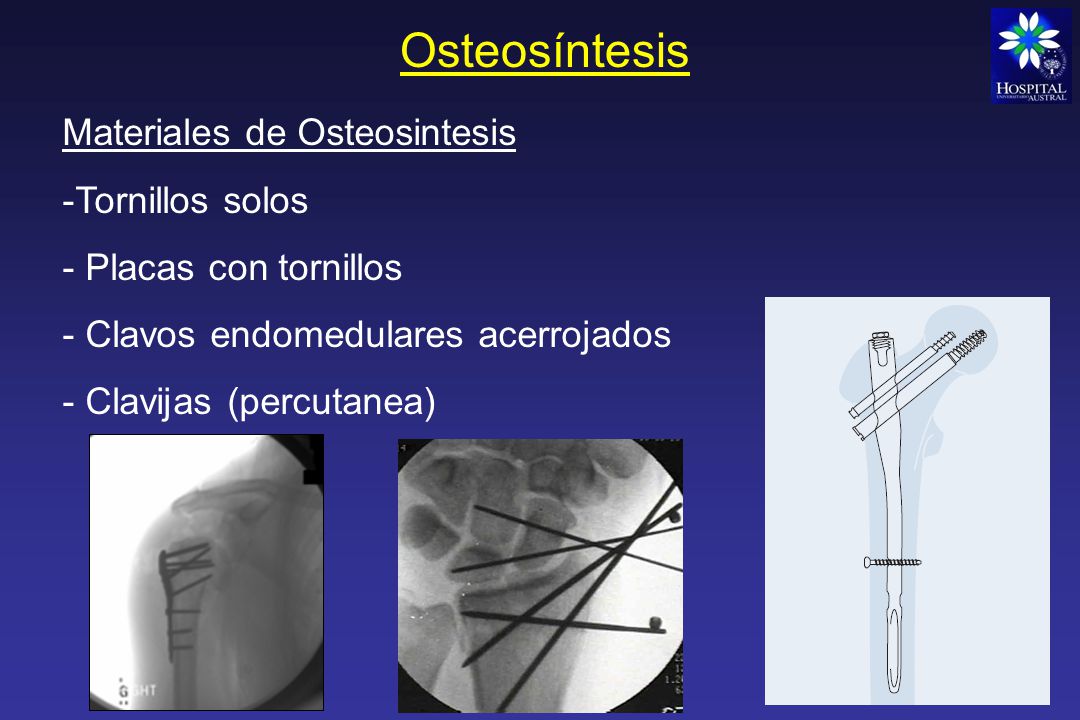 Osteosíntesis Materiales de Osteosintesis Tornillos solos