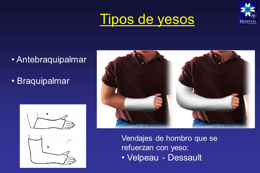 Tipos de yesos Antebraquipalmar Braquipalmar Velpeau - Dessault