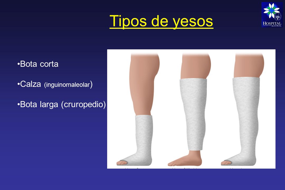 Tipos de yesos Bota corta Calza (inguinomaleolar)