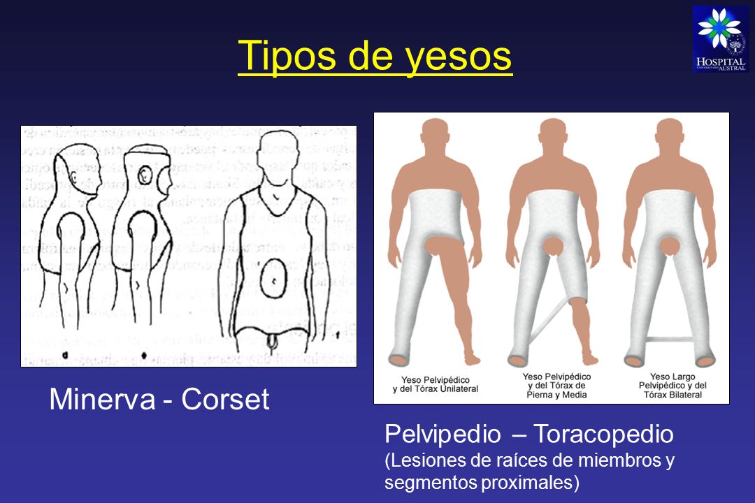 Tipos de yesos Minerva - Corset Pelvipedio – Toracopedio