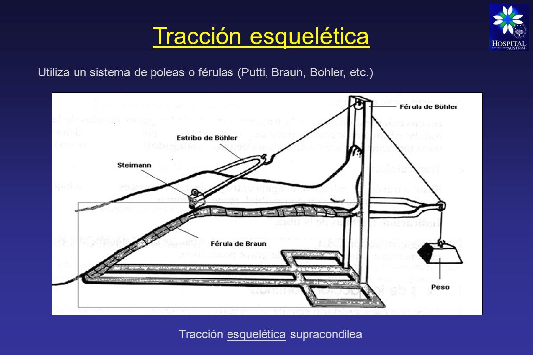 Tracción esquelética Utiliza un sistema de poleas o férulas (Putti, Braun, Bohler, etc.) Tracción esquelética supracondilea.