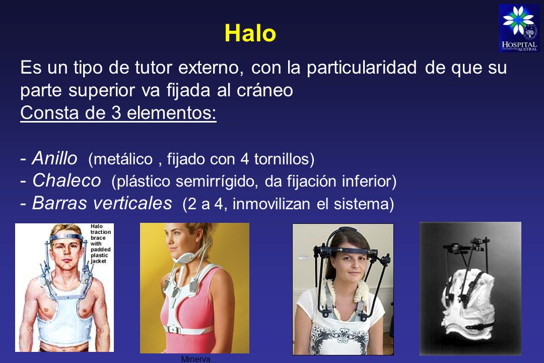 Halo Es un tipo de tutor externo, con la particularidad de que su parte superior va fijada al cráneo.