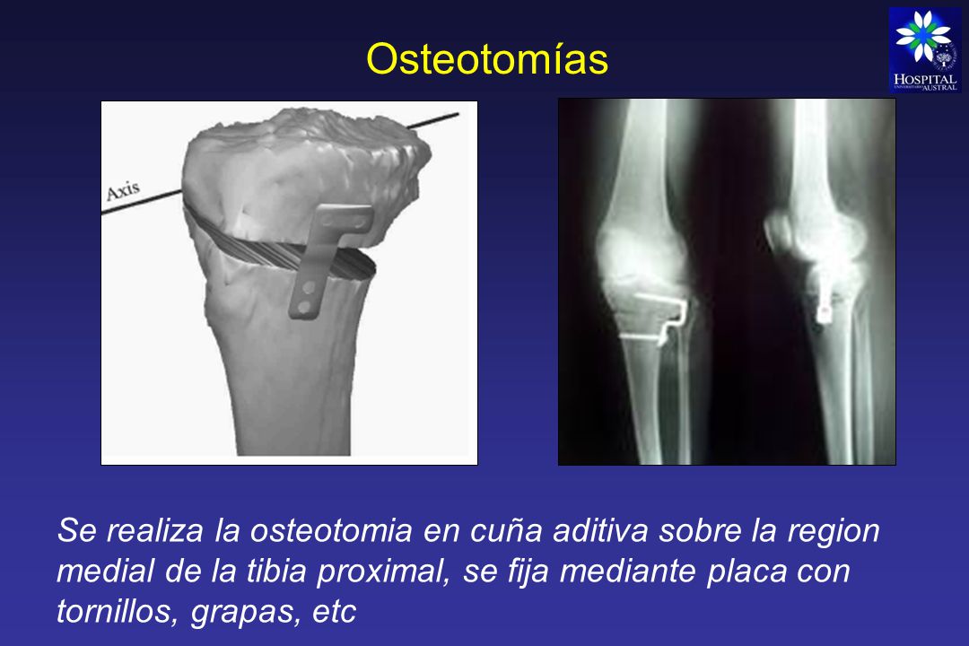 Osteotomías Se realiza la osteotomia en cuña aditiva sobre la region medial de la tibia proximal, se fija mediante placa con tornillos, grapas, etc.