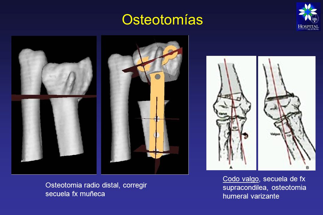 Osteotomías Codo valgo, secuela de fx supracondilea, osteotomia humeral varizante.