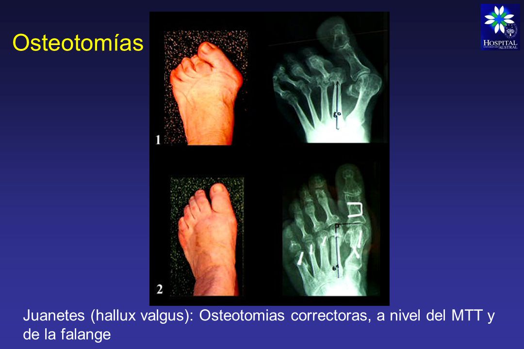 Osteotomías Juanetes (hallux valgus): Osteotomias correctoras, a nivel del MTT y de la falange