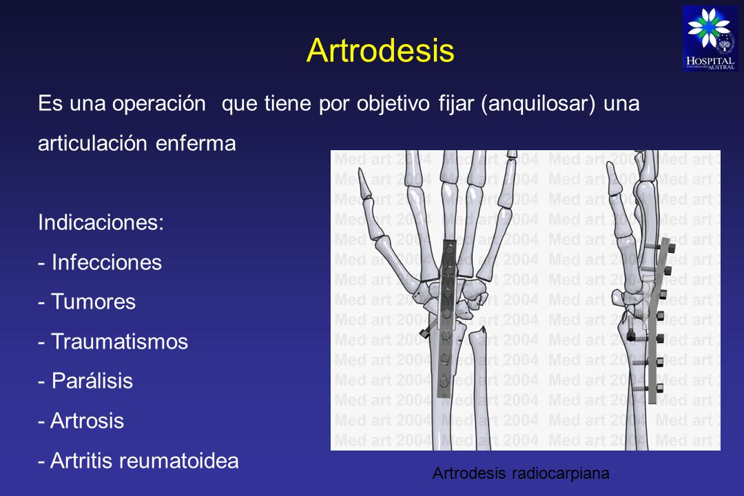 Artrodesis Es una operación que tiene por objetivo fijar (anquilosar) una articulación enferma. Indicaciones: