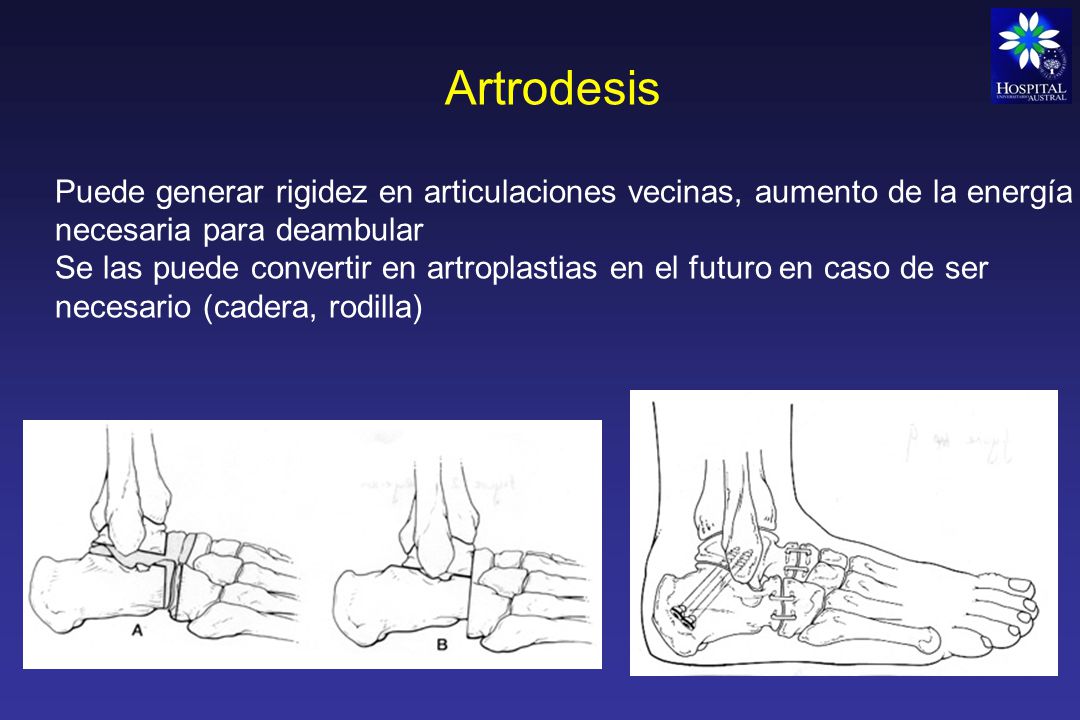 Artrodesis Puede generar rigidez en articulaciones vecinas, aumento de la energía necesaria para deambular.