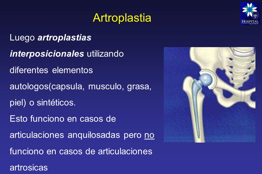Artroplastia Luego artroplastias interposicionales utilizando diferentes elementos autologos(capsula, musculo, grasa, piel) o sintéticos.