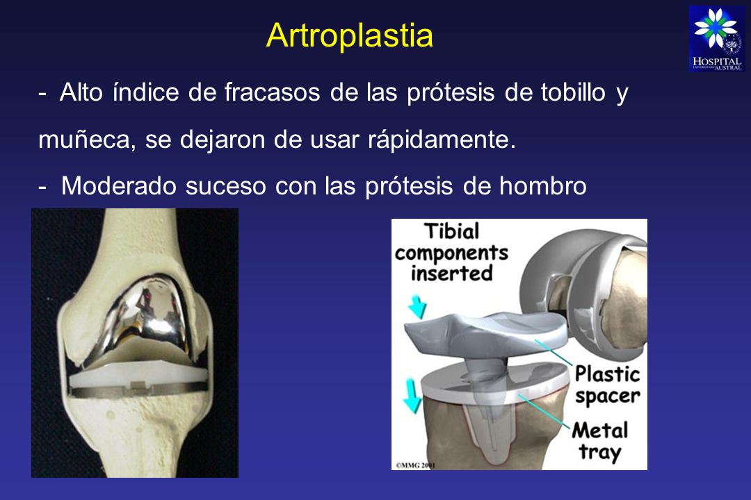 Artroplastia - Alto índice de fracasos de las prótesis de tobillo y muñeca, se dejaron de usar rápidamente.