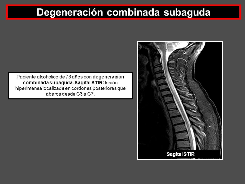 Degeneración combinada subaguda