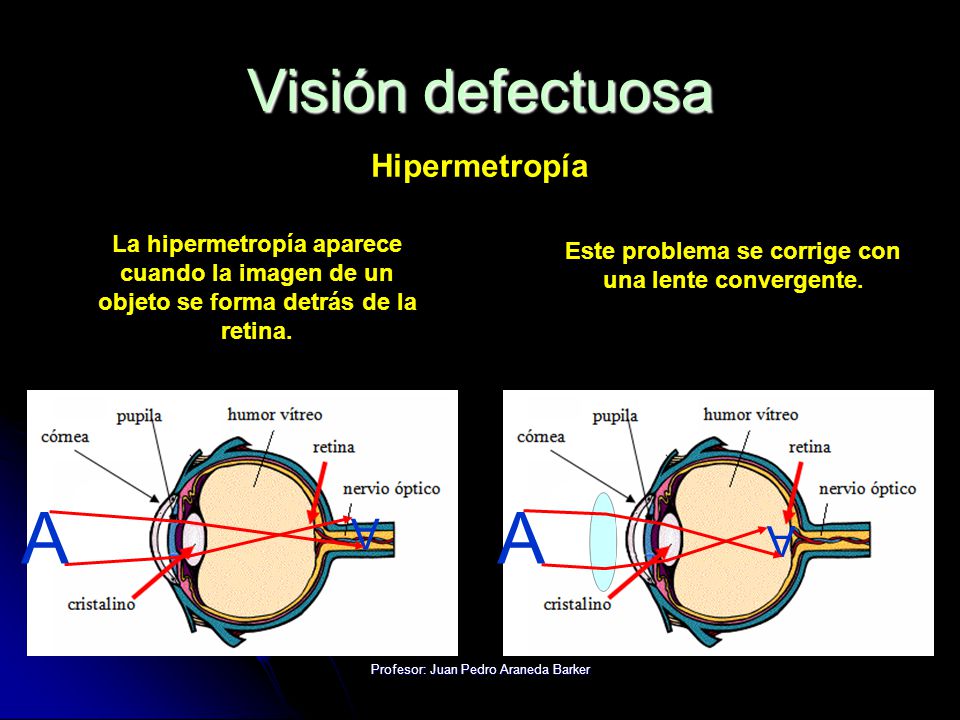 Este problema se corrige con una lente convergente.
