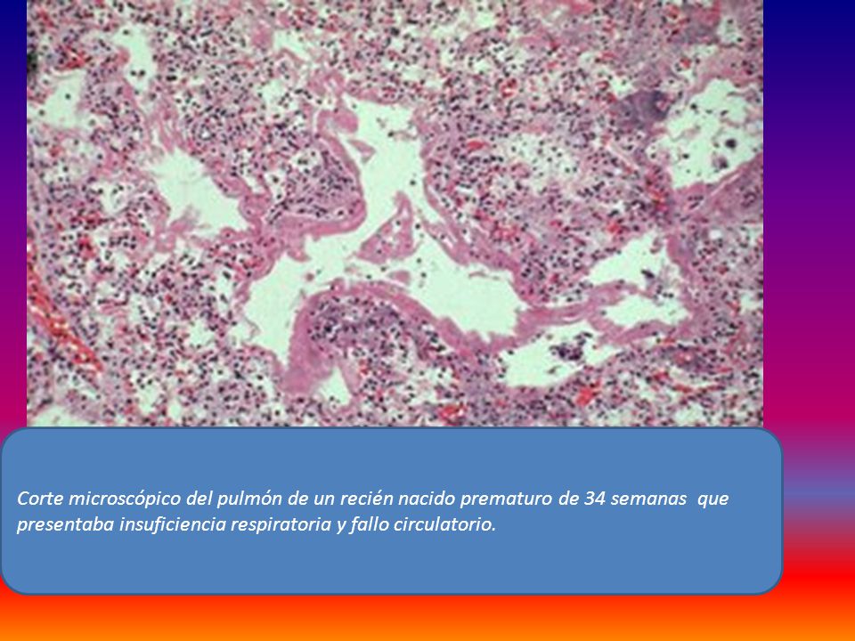 Corte microscópico del pulmón de un recién nacido prematuro de 34 semanas que presentaba insuficiencia respiratoria y fallo circulatorio.