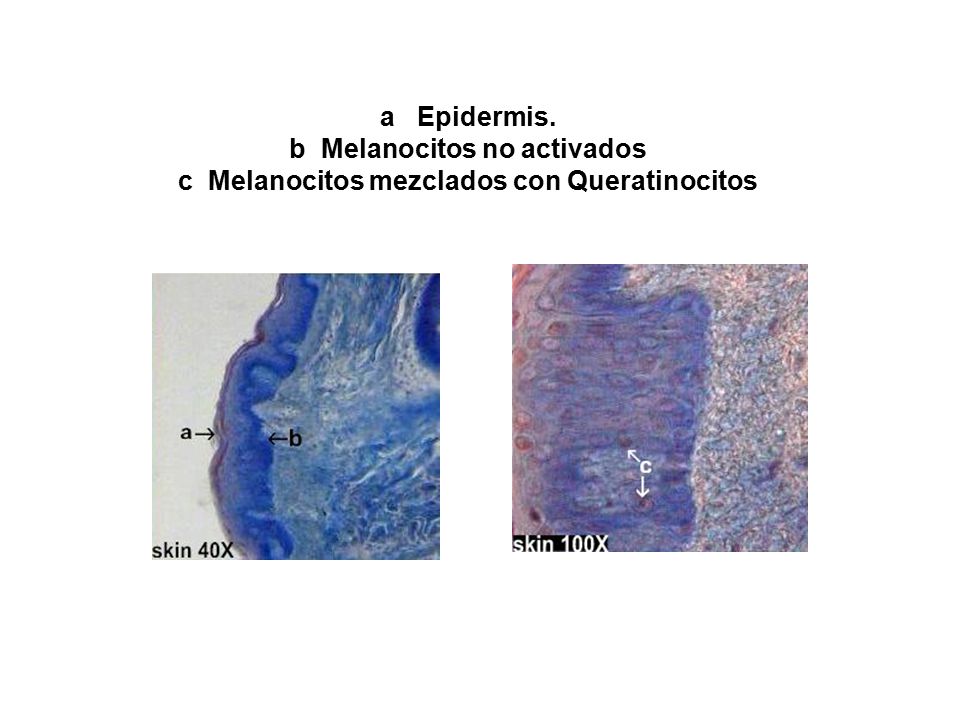 a Epidermis. b Melanocitos no activados c Melanocitos mezclados con Queratinocitos