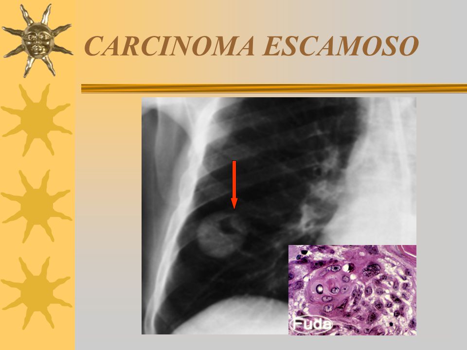 CARCINOMA ESCAMOSO