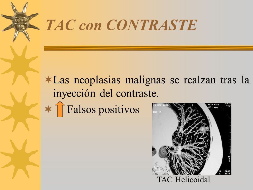TAC con CONTRASTE Las neoplasias malignas se realzan tras la inyección del contraste. Falsos positivos.